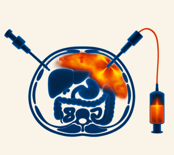 Darstellung der PIPAC-Therapie